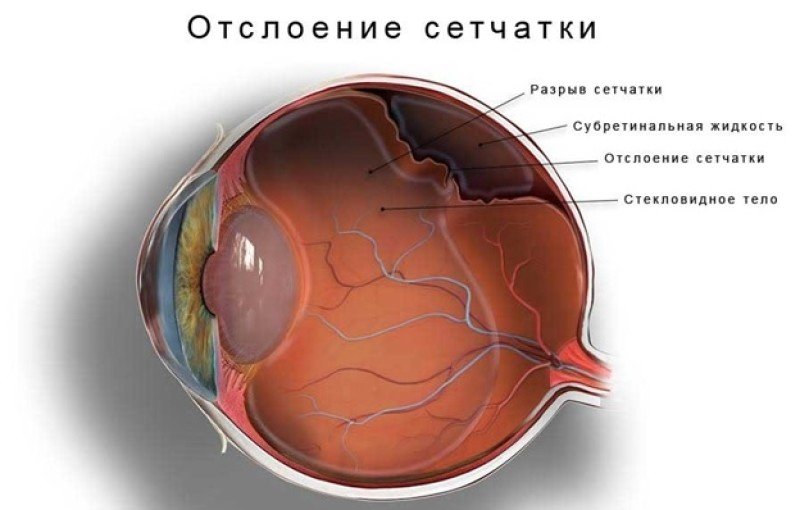 Отслоение сетчатки глаза - 1