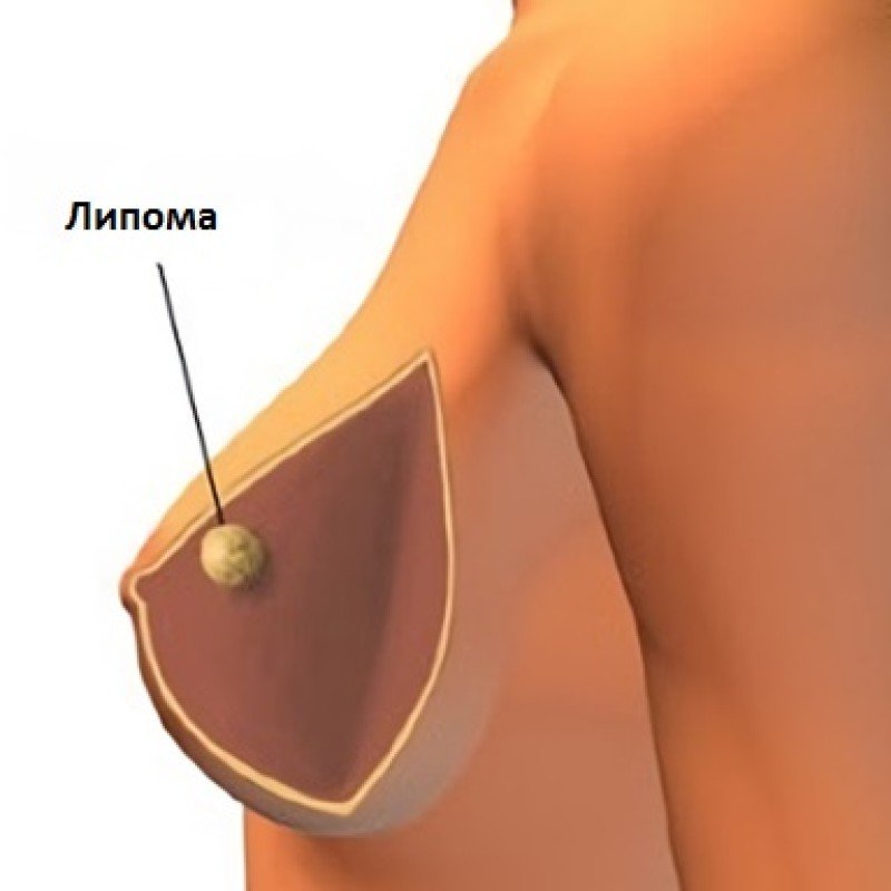 Липома молочной железы - 2